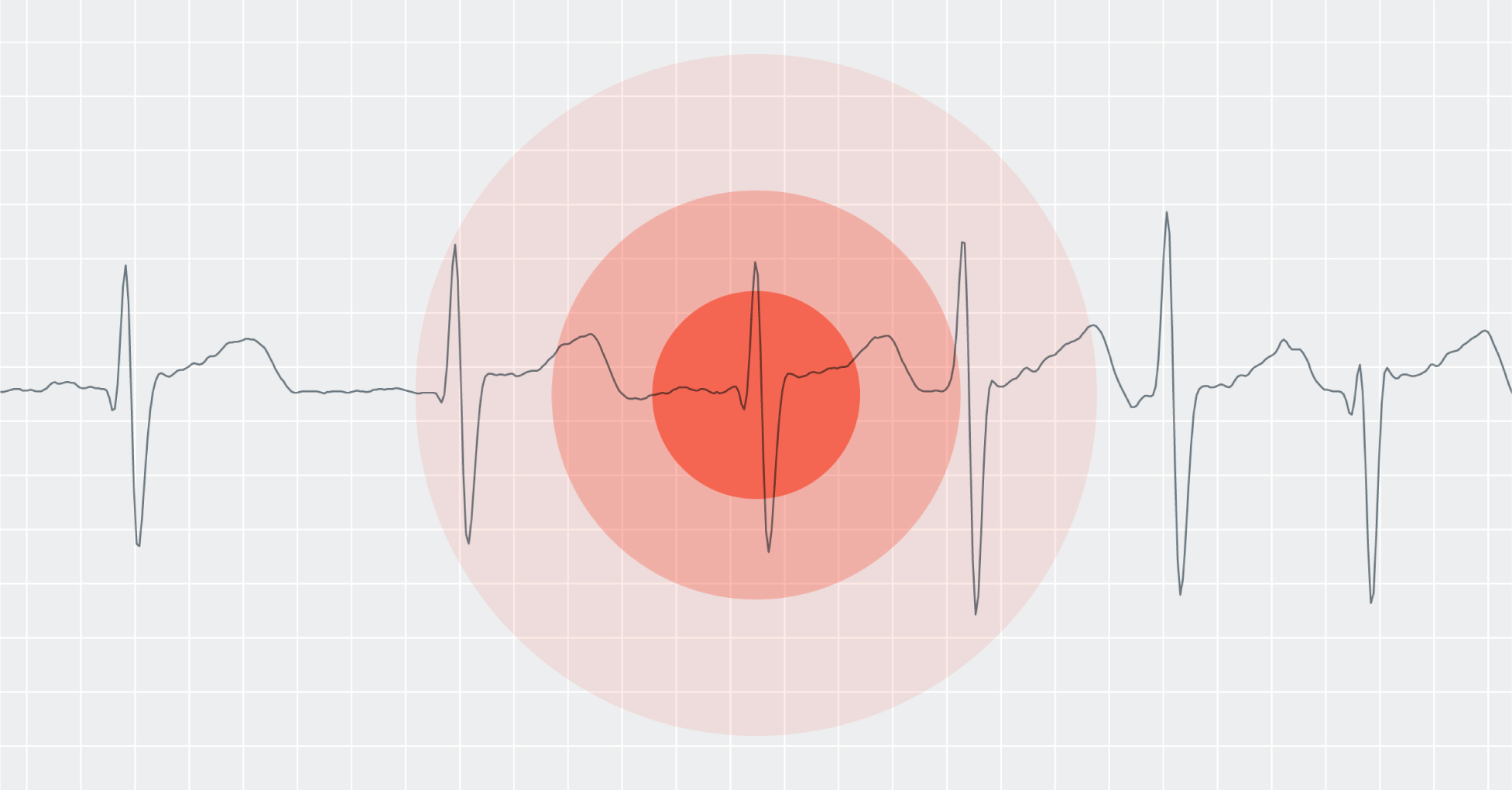 UseCase: The case for atrial fibrillation (AF) as the next vital sign.